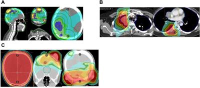 Case report: Pyrotinib and tegafur combined with radiotherapy achieved notable response in HER2-amplified rectal cancer with multiple metastases after multiline treatments